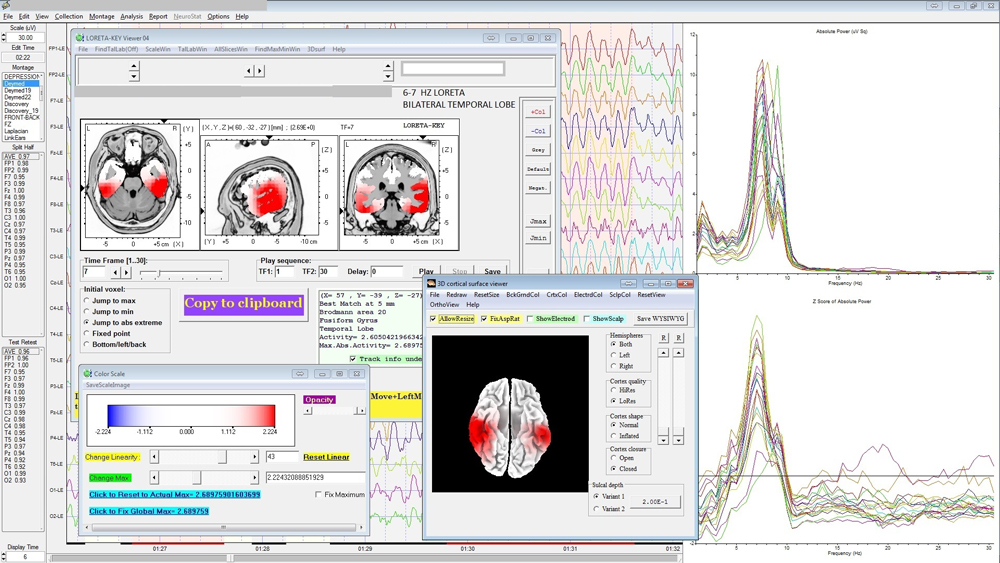 78209 March 2016 Wellness SAMPLE QEEG SPECTRAL ANALYSIS